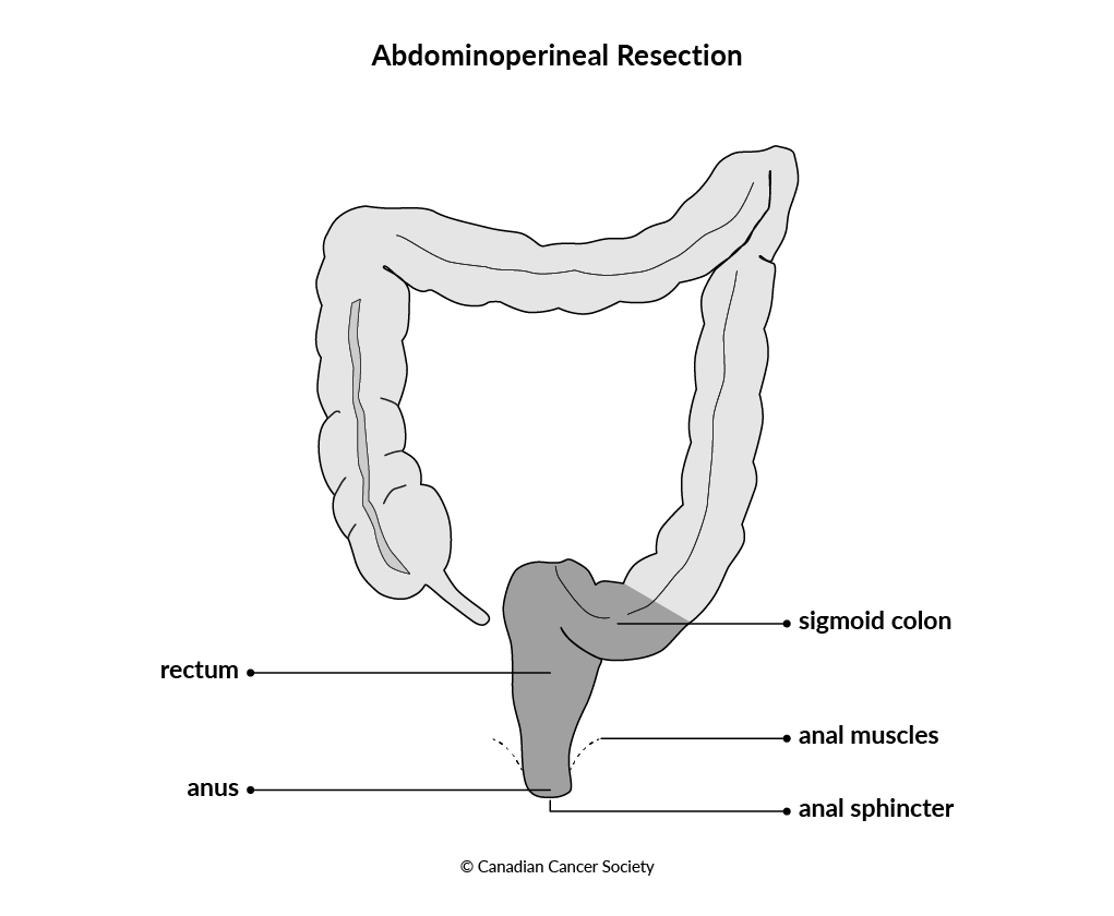 Diagram of an abdominoperineal resection