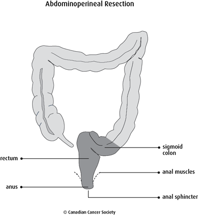Diagram of abdominoperineal resection