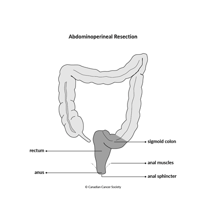 Diagram of an abdominoperineal resection