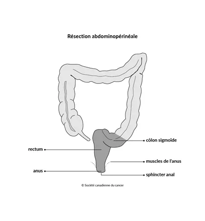 Schéma de la résection abdominopérinéale