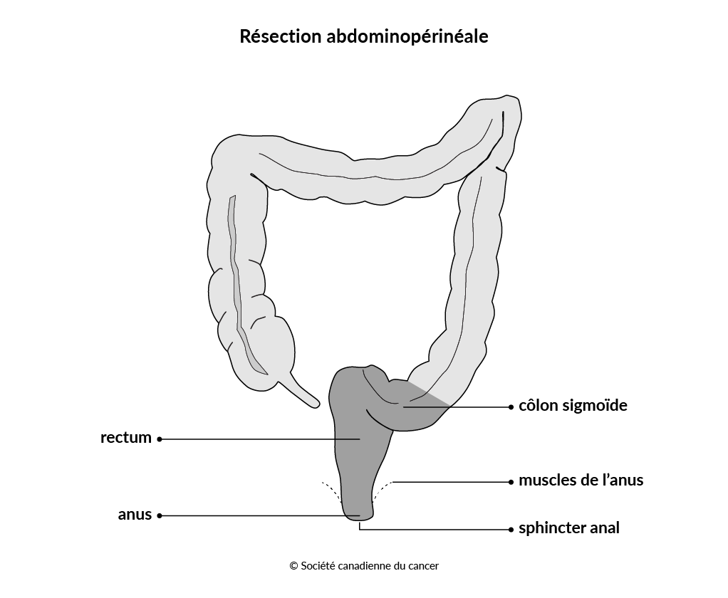 Schéma de la résection abdominopérinéale
