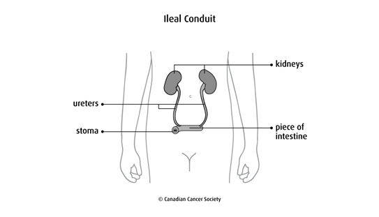 Diagram of an ileal conduit