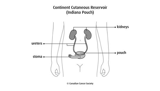 Diagram of a continent cutaneous reservoir (Indiana pouch)