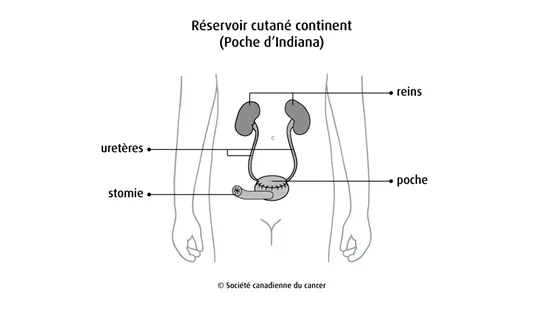 Schéma d'un réservoir cutané continent (poche d'Indiana)