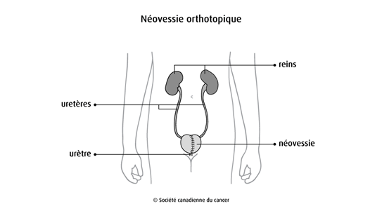 Schéma de la néovessie orthotopique