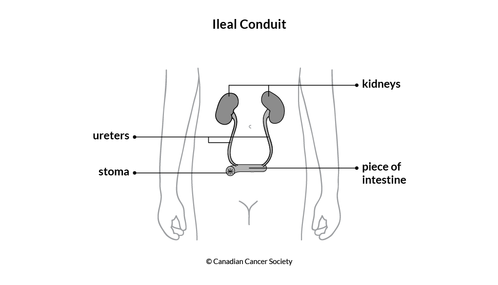 Diagram of an ileal conduit