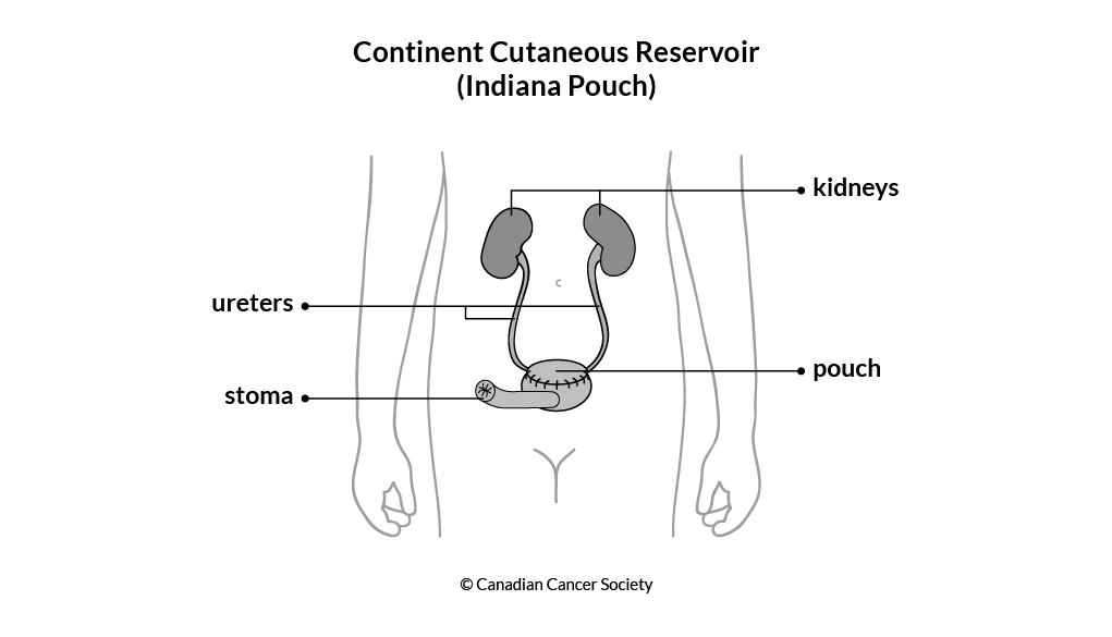 Diagram of a continent cutaneous reservoir (Indiana pouch)