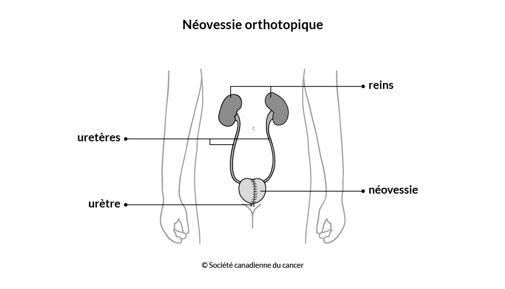 Schéma de la néovessie orthotopique