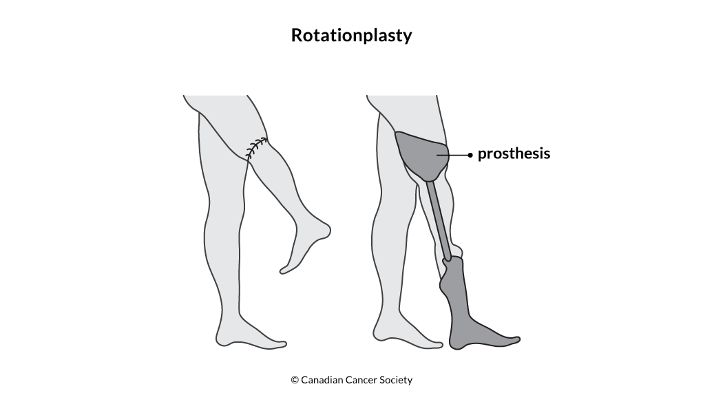 Diagram of rotationplasty