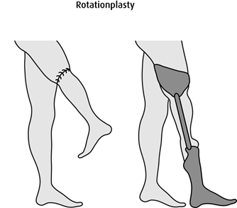 Rotationplasty
