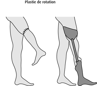 Schéma de la plastie de rotation