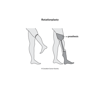 Surgery for childhood bone cancer | Canadian Cancer Society