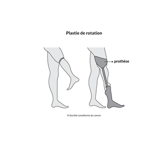 Schéma de la plastie de rotation