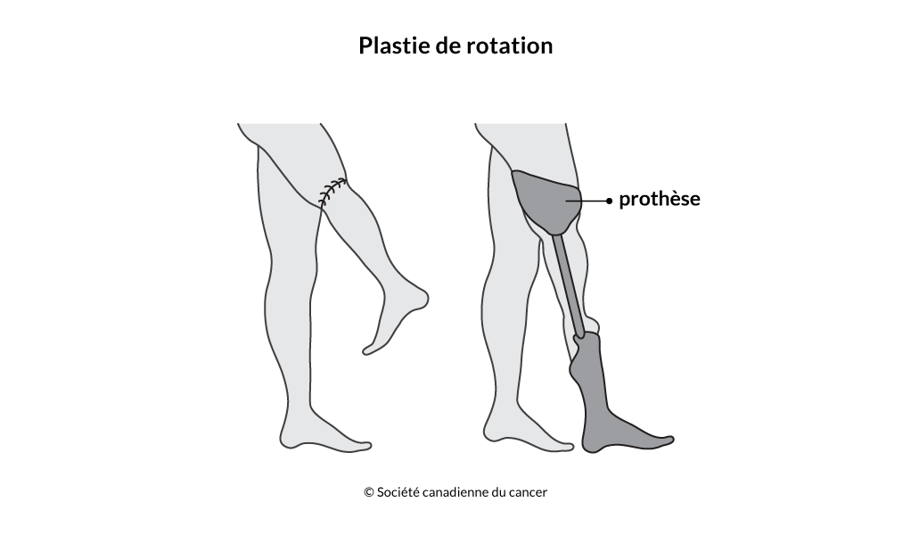 Schéma de la plastie de rotation