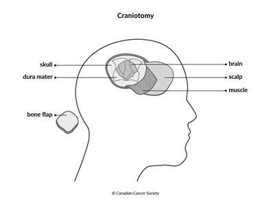 Diagram of a craniotomy