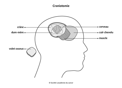 Schéma de la craniotomie