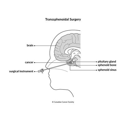 Diagram of transsphenoidal surgery