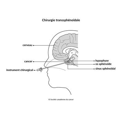 Schéma de la chirurgie transsphénoïdale