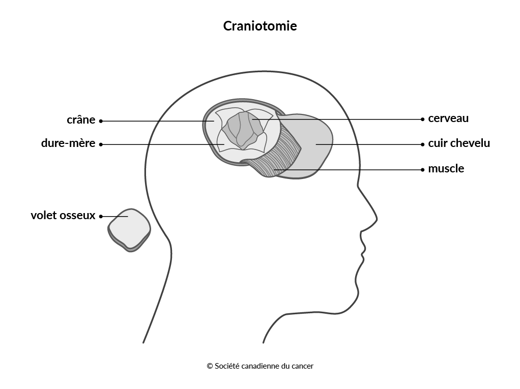 Schéma de la craniotomie 