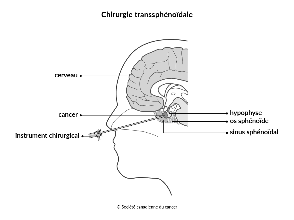 Schéma de la chirurgie transsphénoïdale