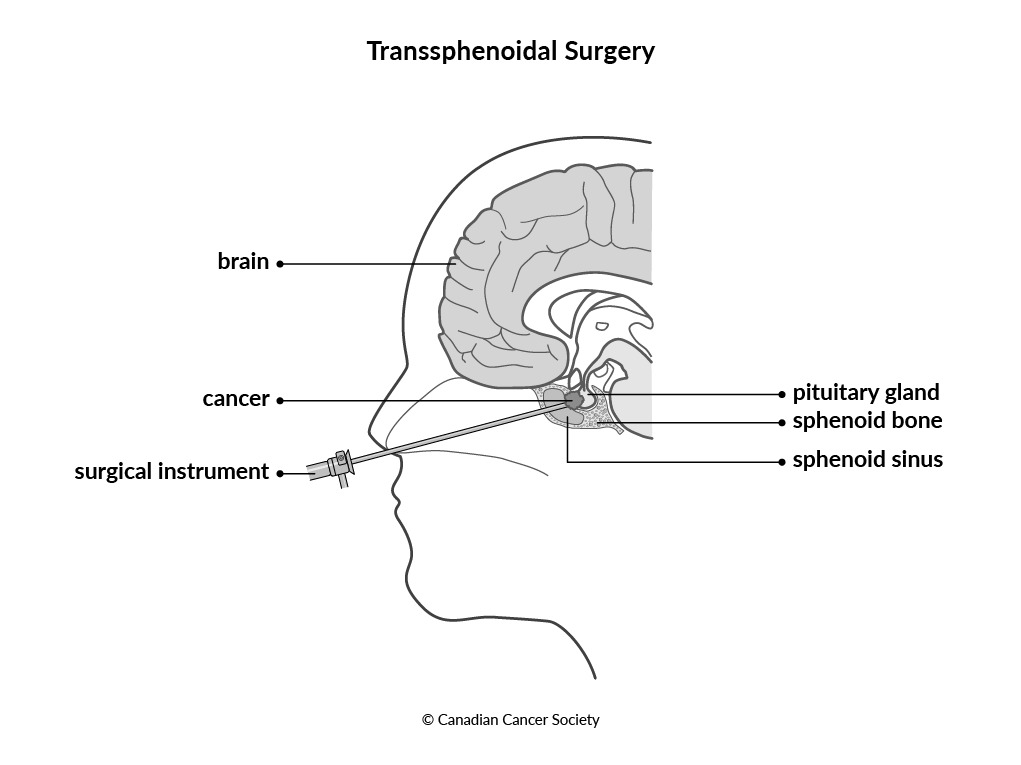 Diagram of transsphenoidal surgery