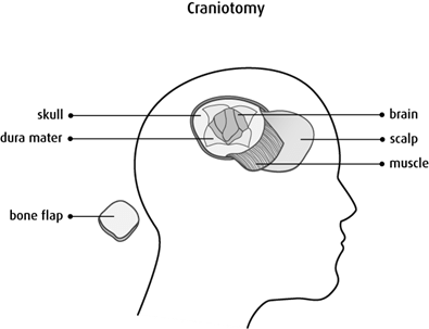 Diagram of a craniotomy