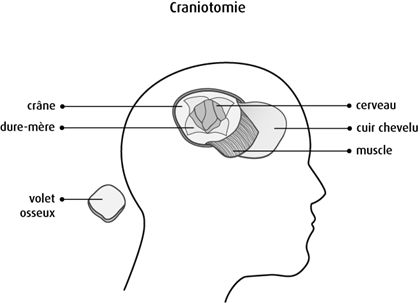 Schéma de la craniotomie