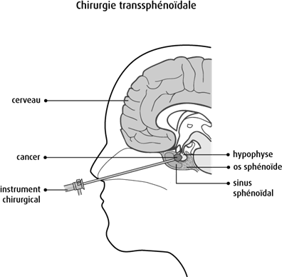 Schéma de la chirurgie transsphénoïdale
