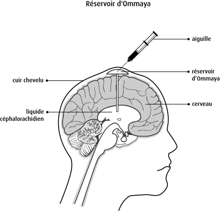 Chimiotherapie Des Tumeurs Au Cerveau Et A La Moelle Epiniere Chez L Enfant Societe Canadienne Du Cancer Chimiotherapie Des Tumeurs Au Cerveau Et A La Moelle Epiniere Chez L Enfant Societe Canadienne Du Cancer