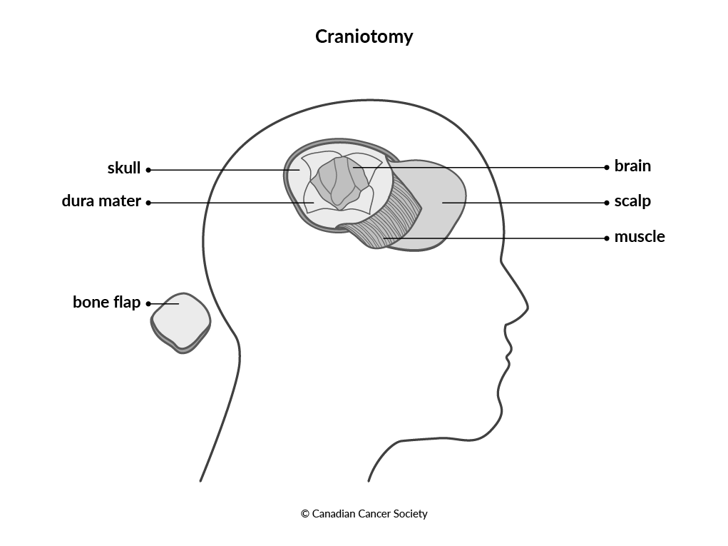 Diagram of a craniotomy