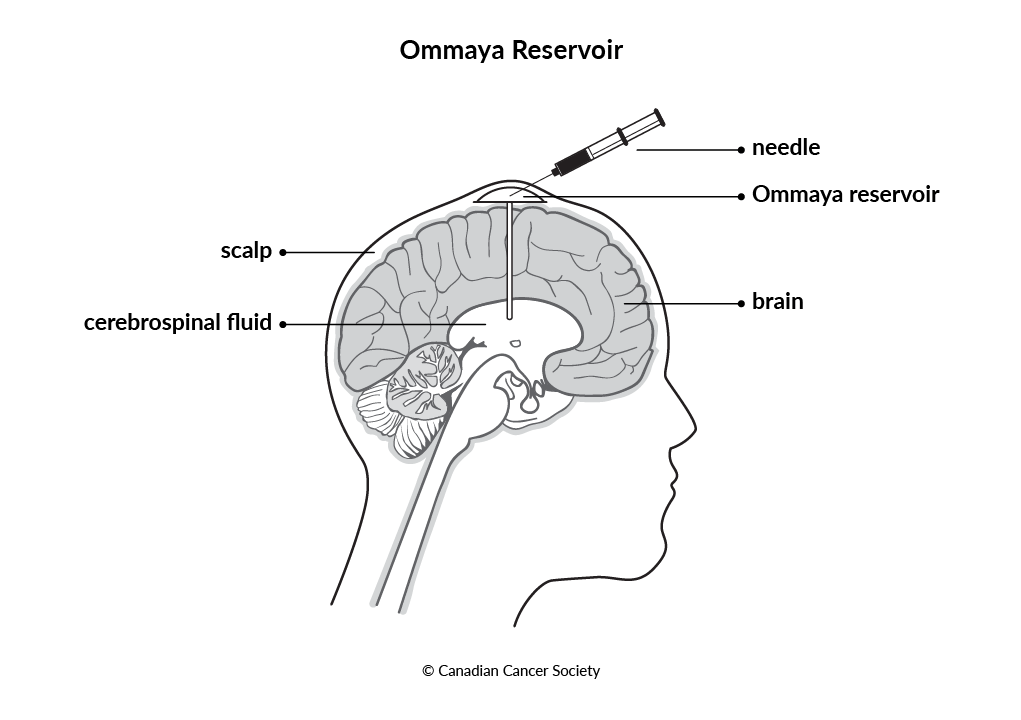 Diagram of an Ommaya reservoir