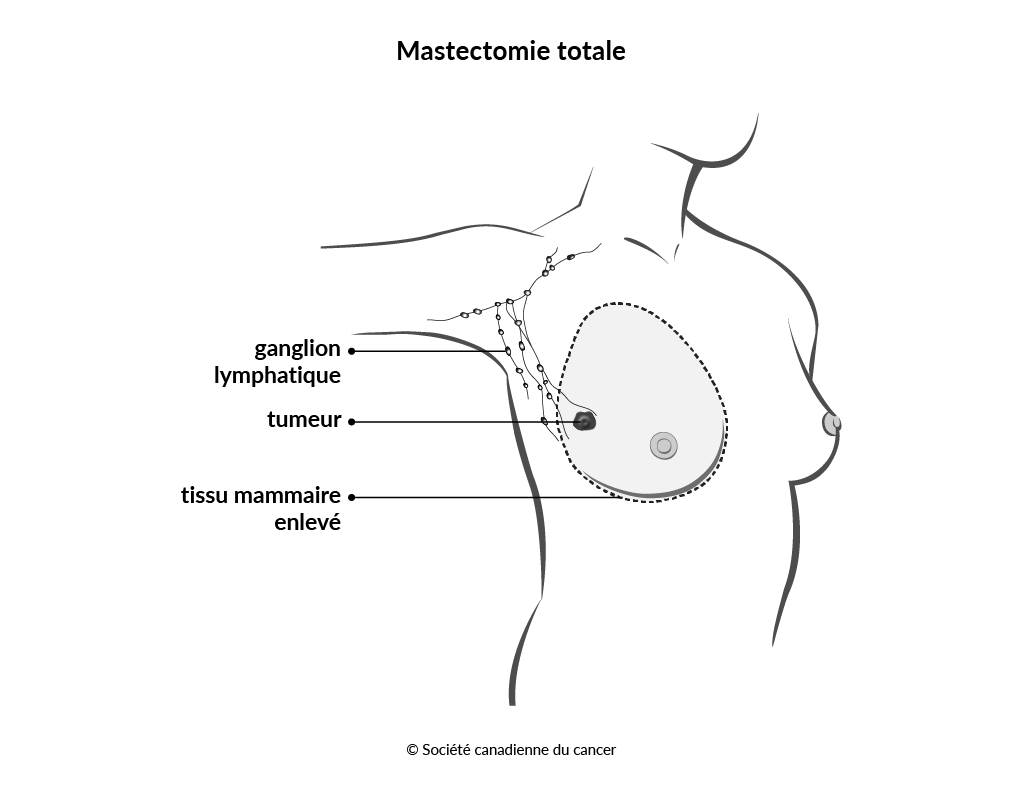 Schéma de la mastectomie totale