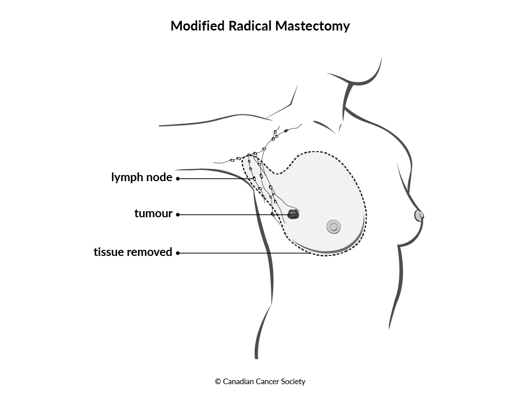 Diagram of modified radical mastectomy