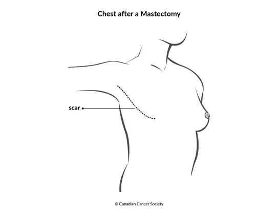 Diagram of chest after a mastectomy
