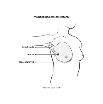 Diagram of modified radical mastectomy
