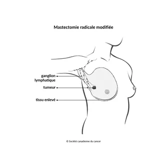 Schéma de la mastectomie radicale modifiée