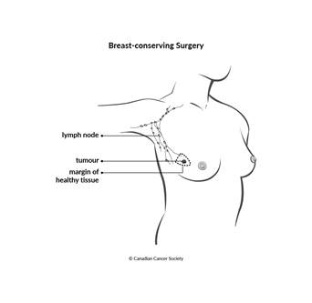 Diagram of breast-conserving surgery