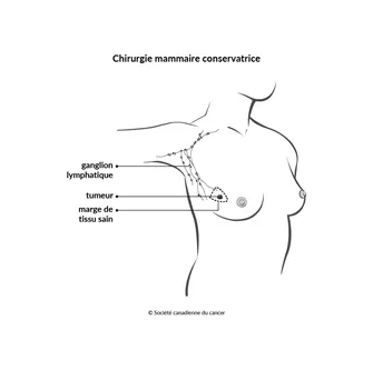 Schéma de la chirurgie mammaire conservatrice