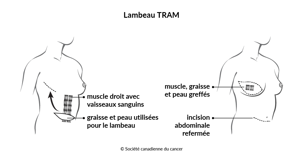 Schéma d'un lambeau TRAM