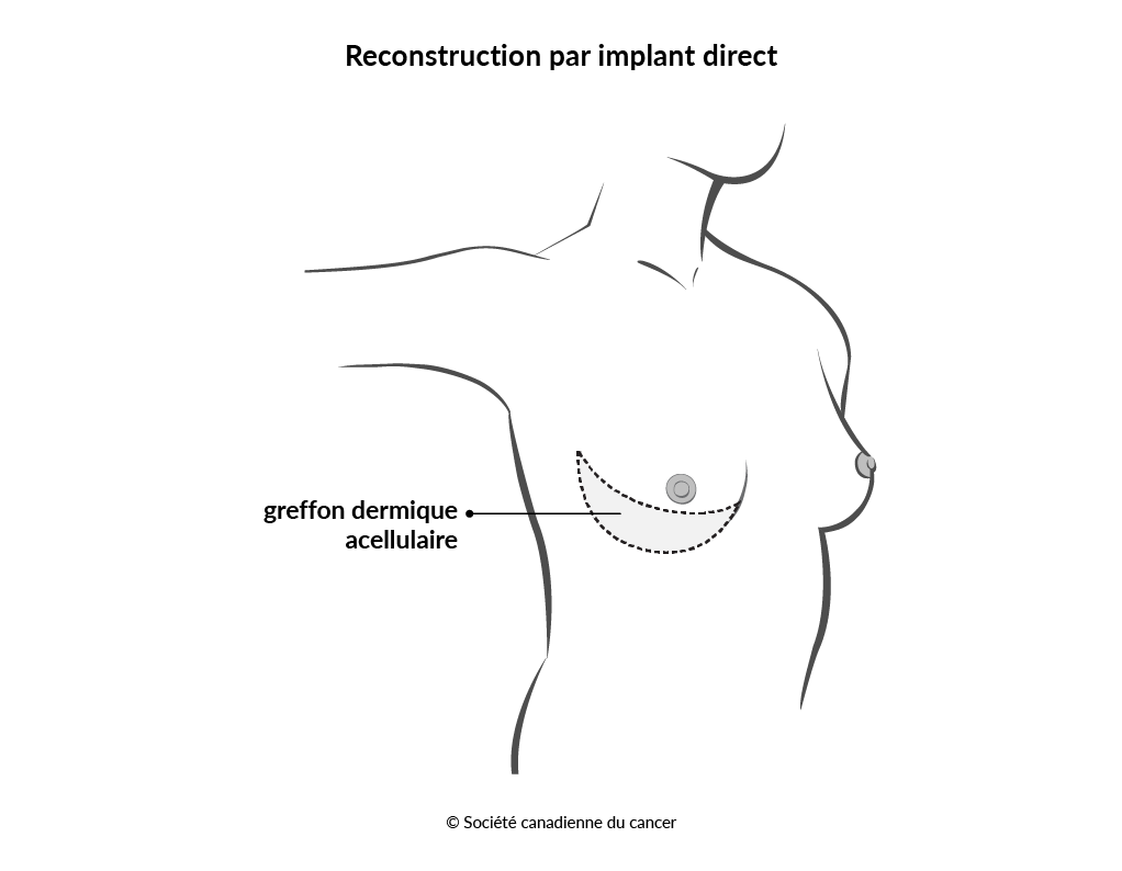 Schéma de la reconstruction par implant direct