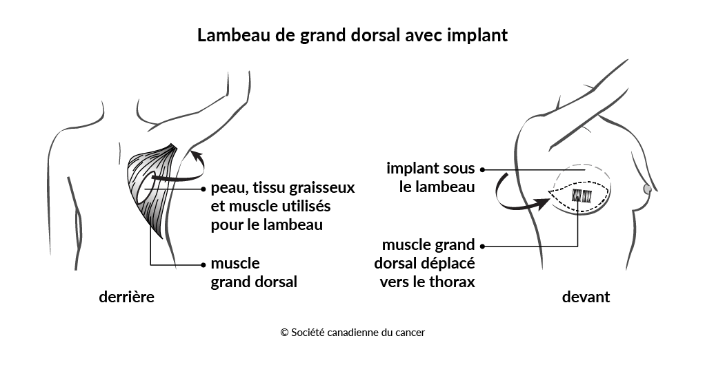 Schéma d'un lambeau de grand dorsal avec implant