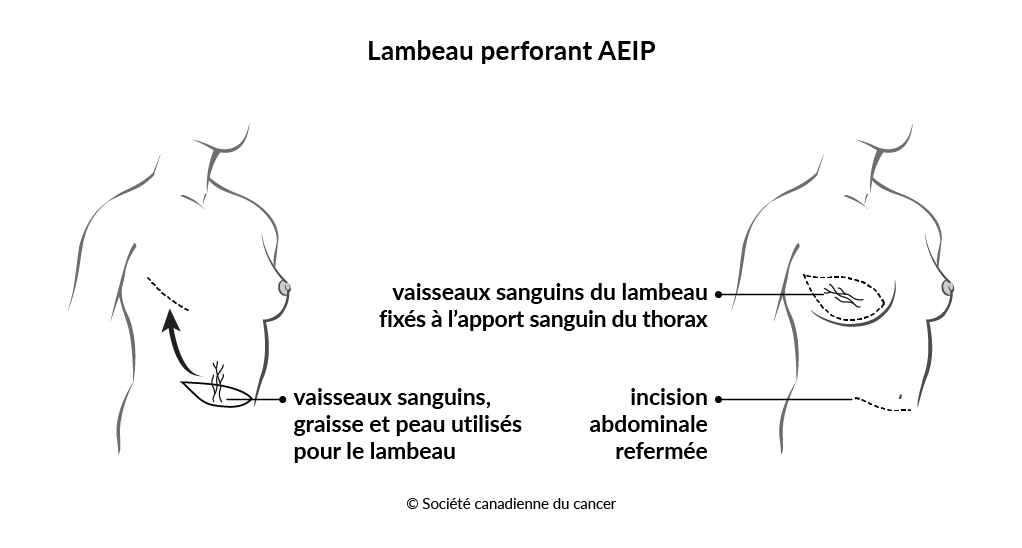 Schéma d'un lambeau perforant AEIP