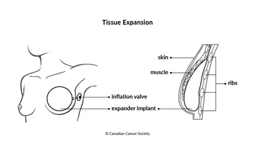 Diagram of tissue expansion