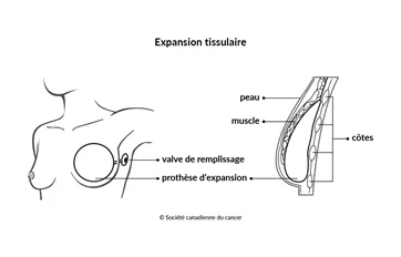 Schéma de l’expansion tissulaire