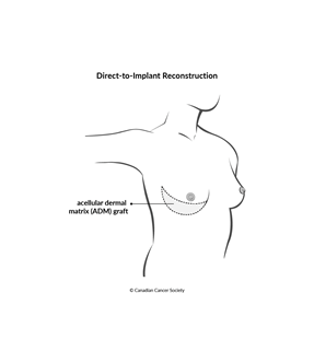 Diagram of direct-to-implant reconstruction