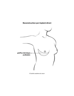 Schéma de la reconstruction par implant direct