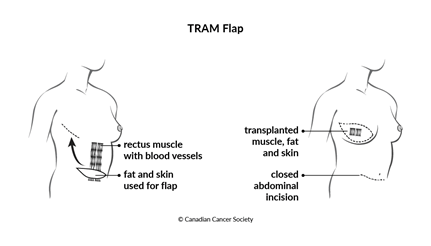 Diagram of a TRAM flap