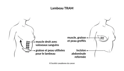 Schéma d'un lambeau TRAM