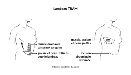 Schéma d'un lambeau TRAM