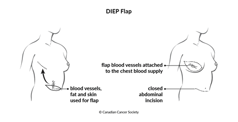 Diagram of a DIEP flap